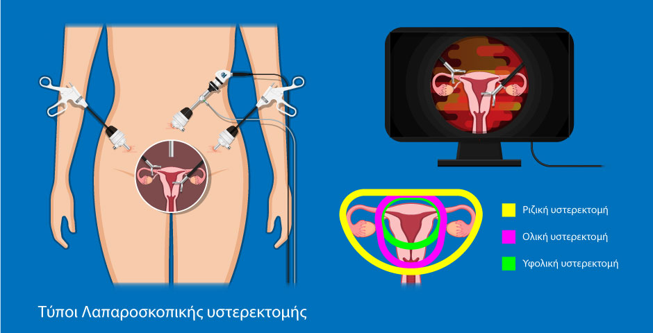 Λαπαροσκοπική Αφαίρεση Μήτρας