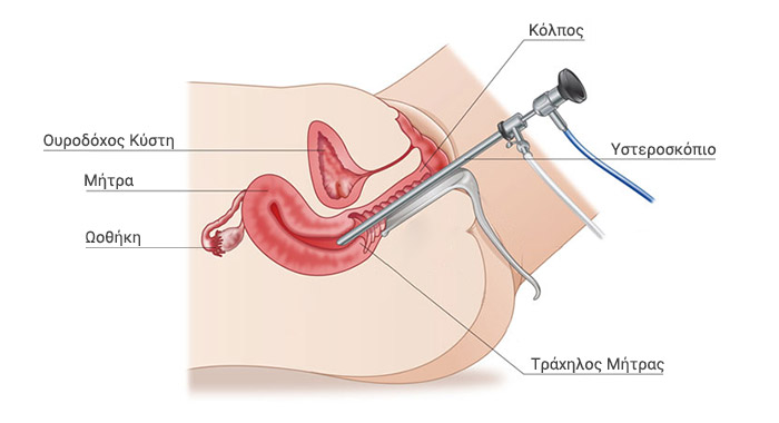 Υστεροσκόπηση και γυναικολογικές παθήσεις 
