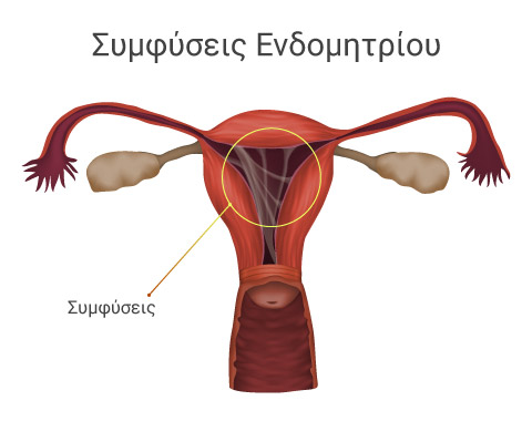 Συμφύσεις μήτρας και υστεροσκόπηση