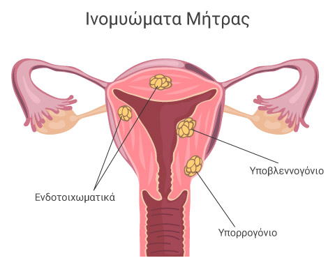 Αφαίρεση ινομυωμάτων υστεροσκοπικά